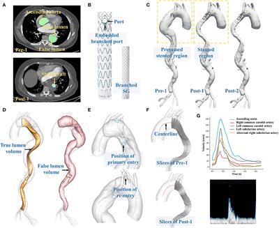 Functional Evaluation of Embedded Modular Single-Branched Stent Graft: Application to Type B Aortic Dissection With Aberrant Right Subclavian Artery